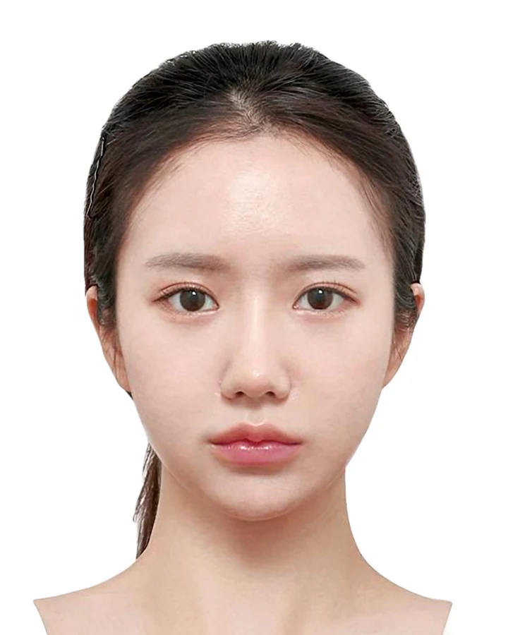 CASE 01 정면 수술 후