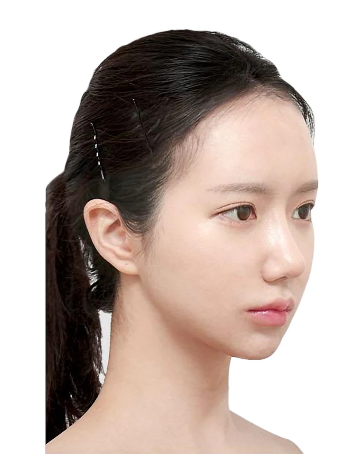 CASE 01 측면 수술 후